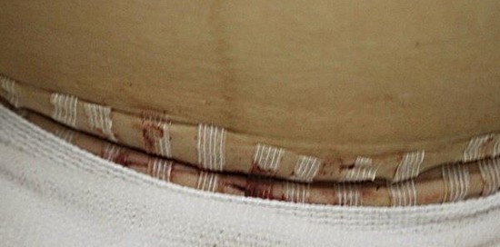 c section scar after 1 year