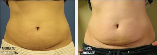 coolsculptingsidebyside