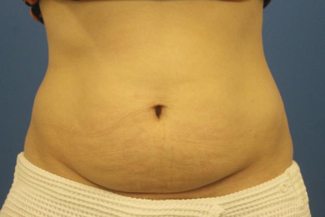 pre-coolsculpting before