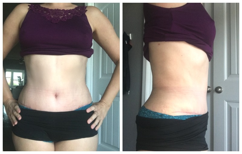 Fading bruises and fading scar 4 weeks after tummy tuck and liposuction