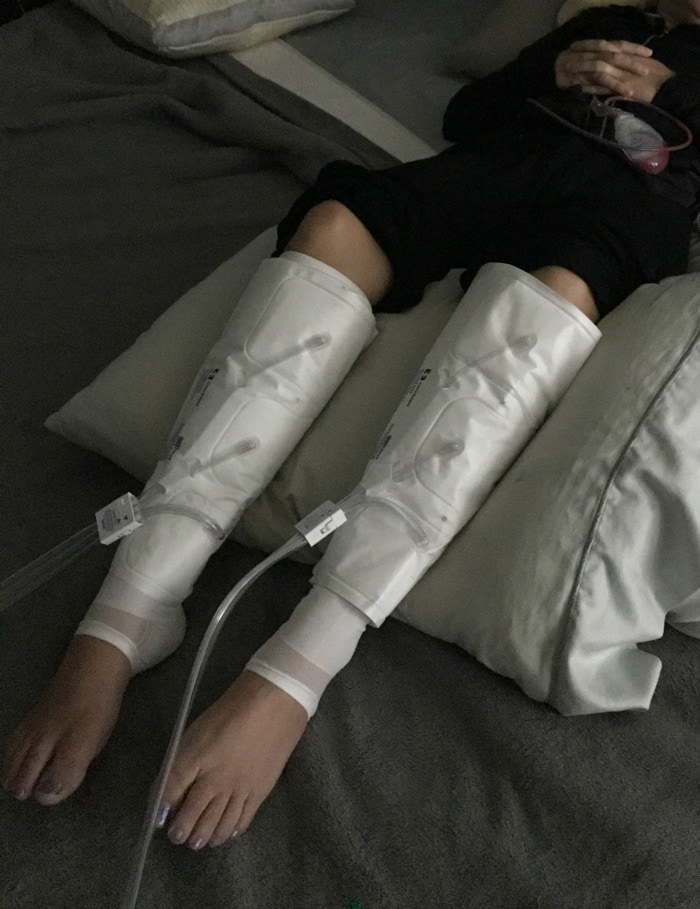 Compression sleeves on legs first week after liposuction and tummy tuck