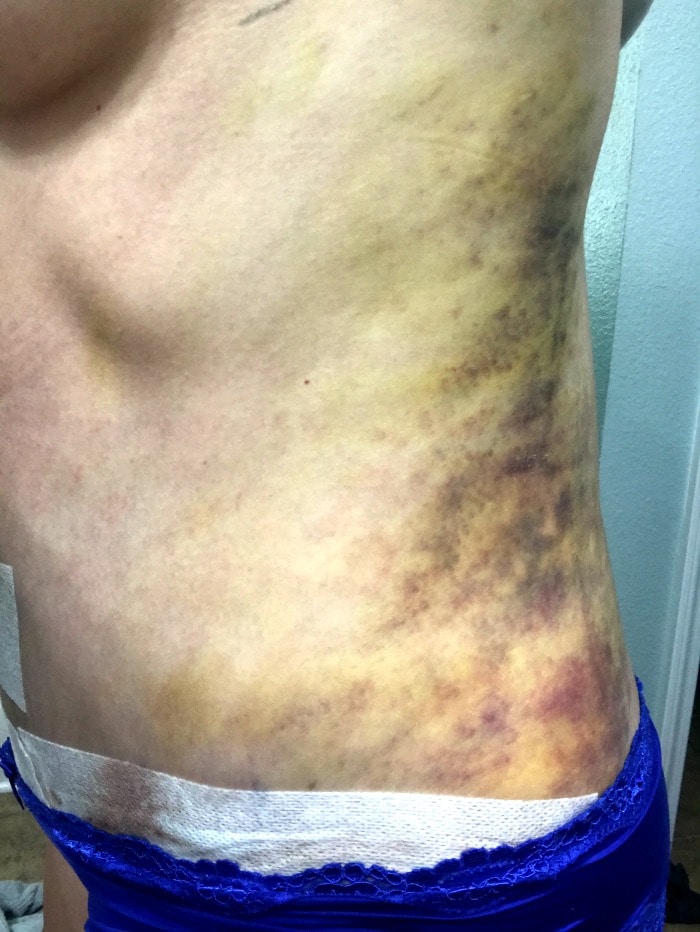 Lipo recovery picture after 4 days
