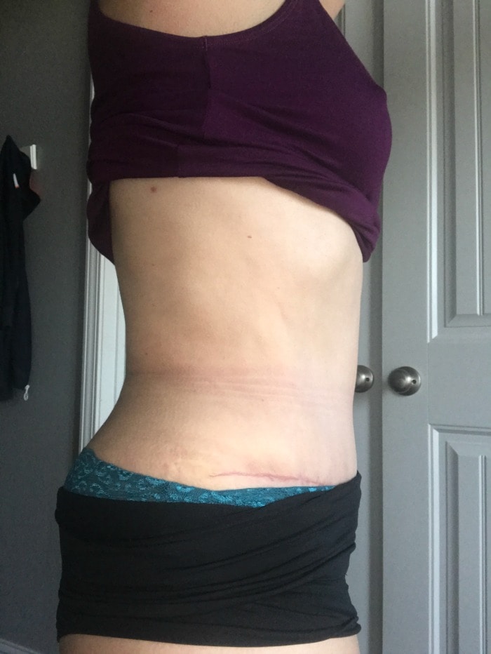 Liposuction recovery after 4 weeks and tummy tuck scar