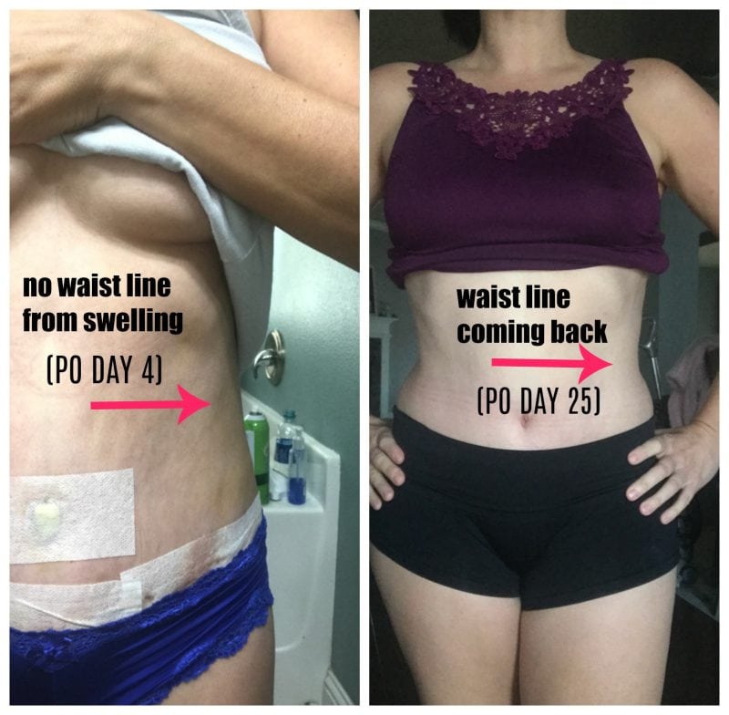 Significant lipo swelling day 4 versus visible waistline on day 25 of recovery.