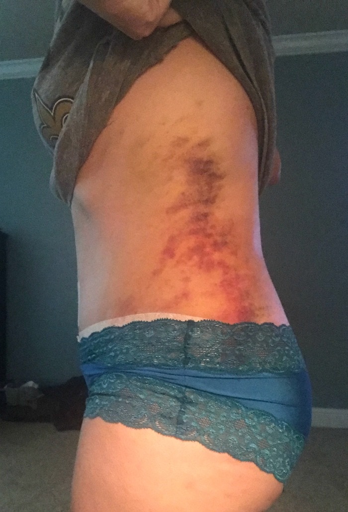 Lipo recovery bruising after 6 days