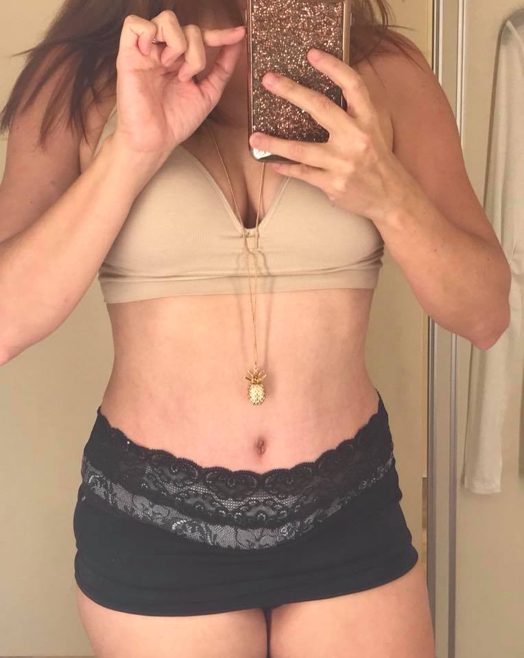Tummy tuck and liposuction 4 weeks post-op
