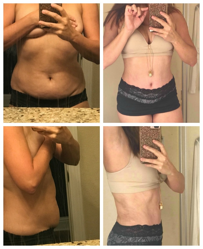Tummy tuck and liposuction results pictures