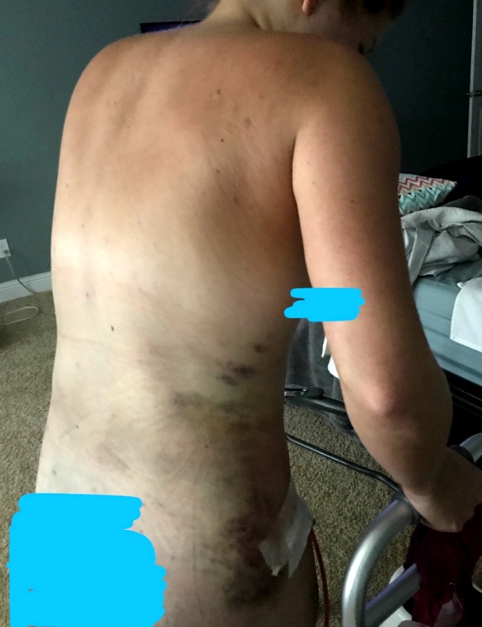 Liposuction and tummy tuck post operation bruising and using a walker
