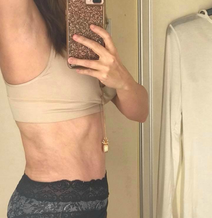 4 weeks after tummy tuck and liposuction there is minimal swelling and bruising