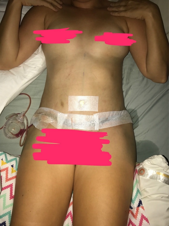 Post-op photo tummy tuck and liposuction with pump first day after surgery