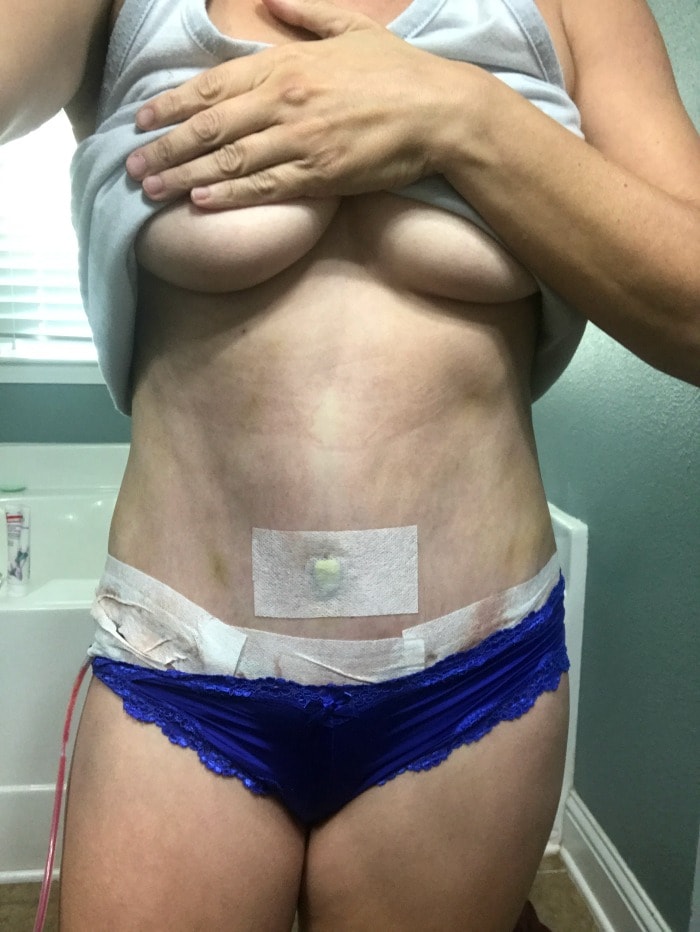 Tummy tuck post-op day 4 with drains